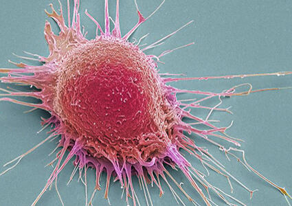 Prostate cancer 